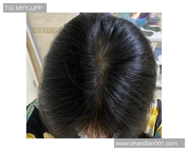 秃顶足球球星如何应对发量困扰与职业生涯的挑战 秃顶足球球星如何应对发量困扰与职业生涯的挑战